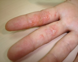 Eczema Treatment